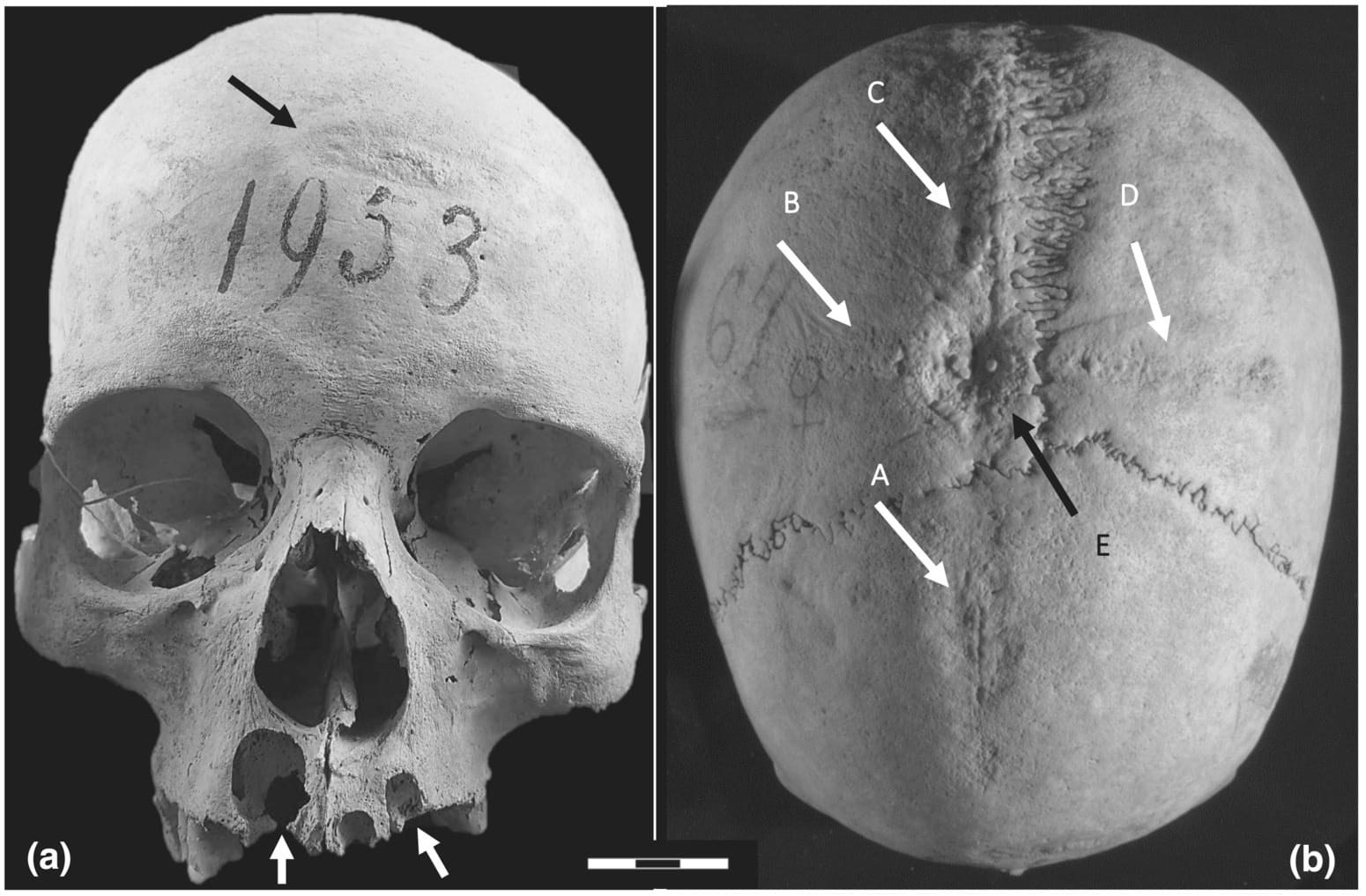 human skull with markings and annotation