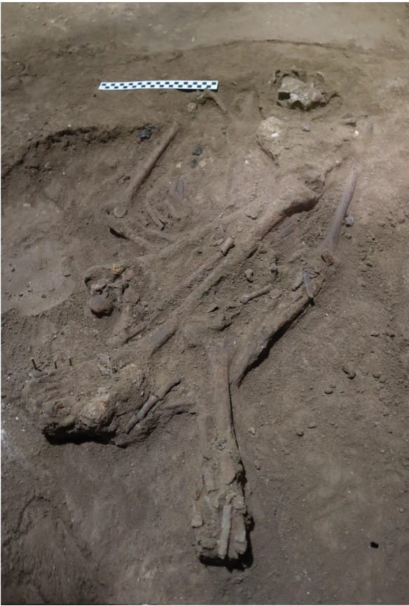 unearthed evidence of surgical amputation